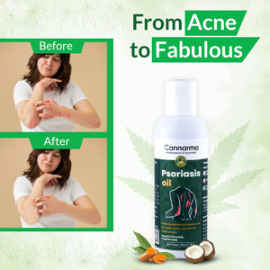 Shop Cannarma Ayurvedic Psoriasis Oil 100ml for Skin & Scalp